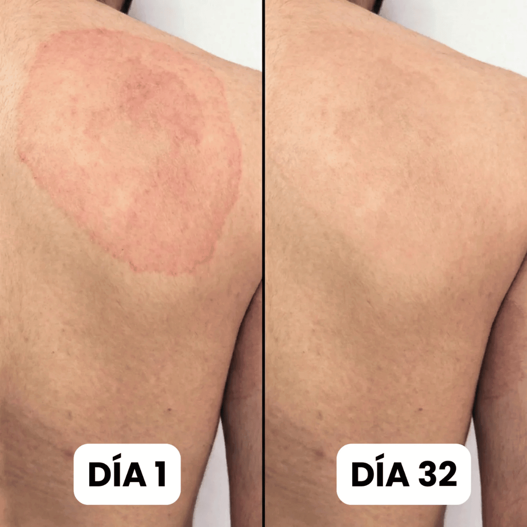 DermaForte: Erradica hongos y alivia la picazón severa