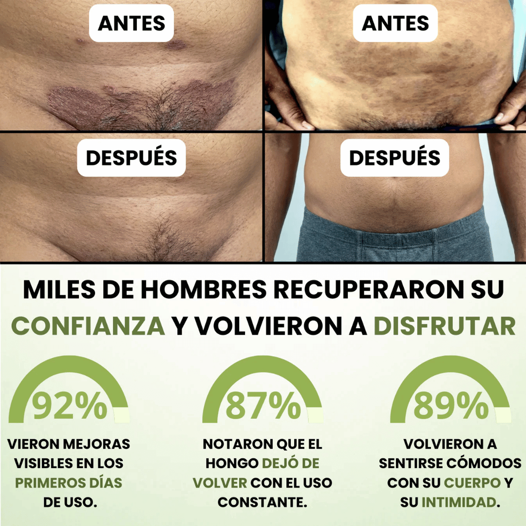 DermaForte: Erradica hongos y alivia la picazón severa