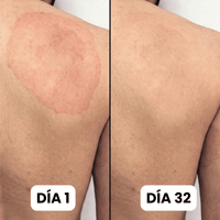 DermaForte: Erradica hongos y alivia la picazón severa