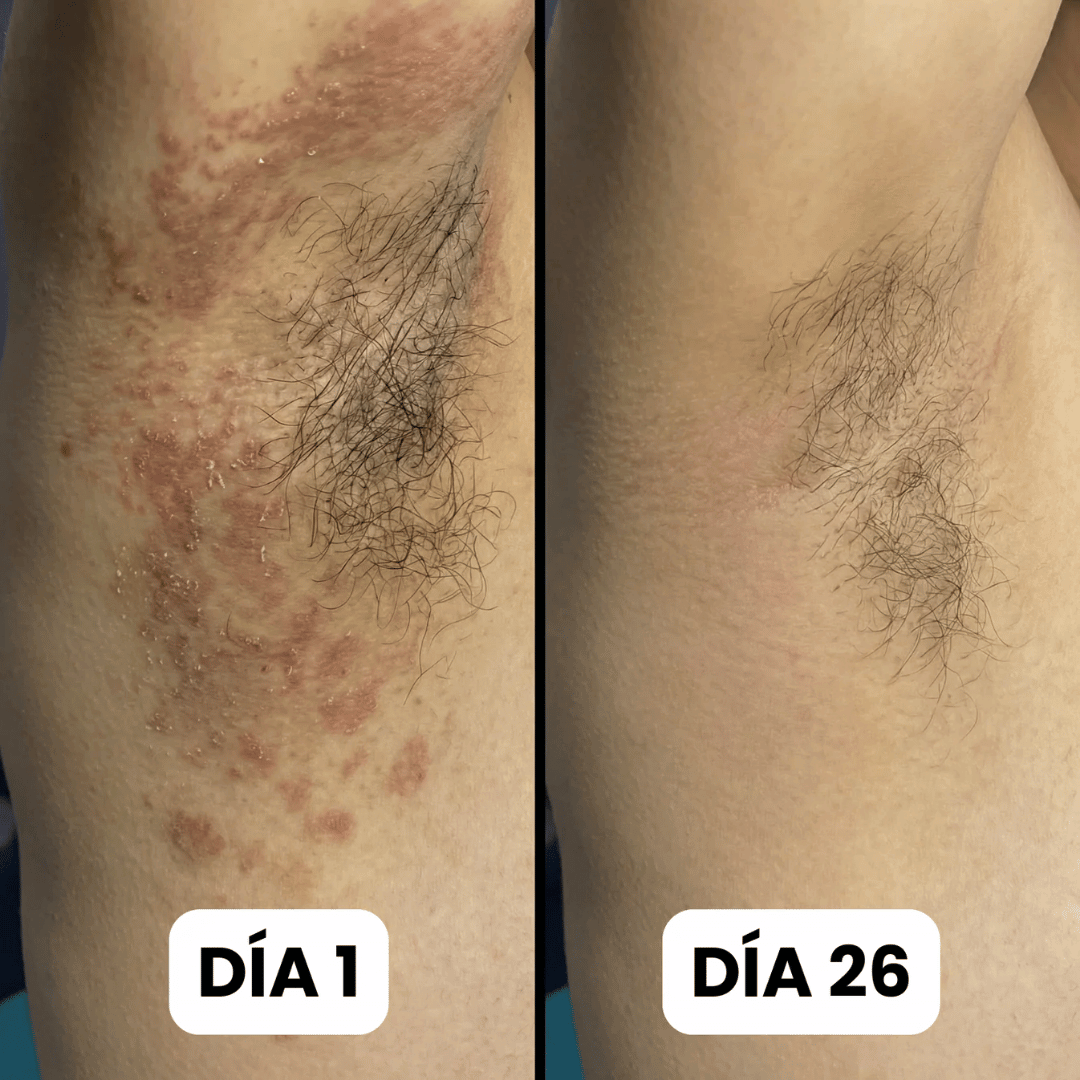 DermaForte: Erradica hongos y alivia la picazón severa