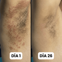 DermaForte: Erradica hongos y alivia la picazón severa