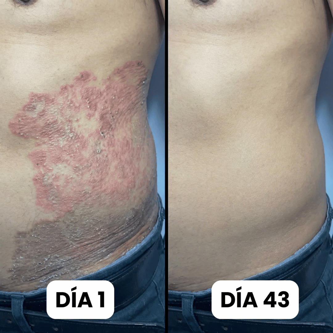 DermaForte: Erradica hongos y alivia la picazón severa