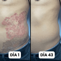 DermaForte: Erradica hongos y alivia la picazón severa